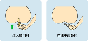 现货日本 武田药品 痔疮神药 BORRAGINOLA 痔疮膏 注入式软膏 疼痛 出血 内外痔